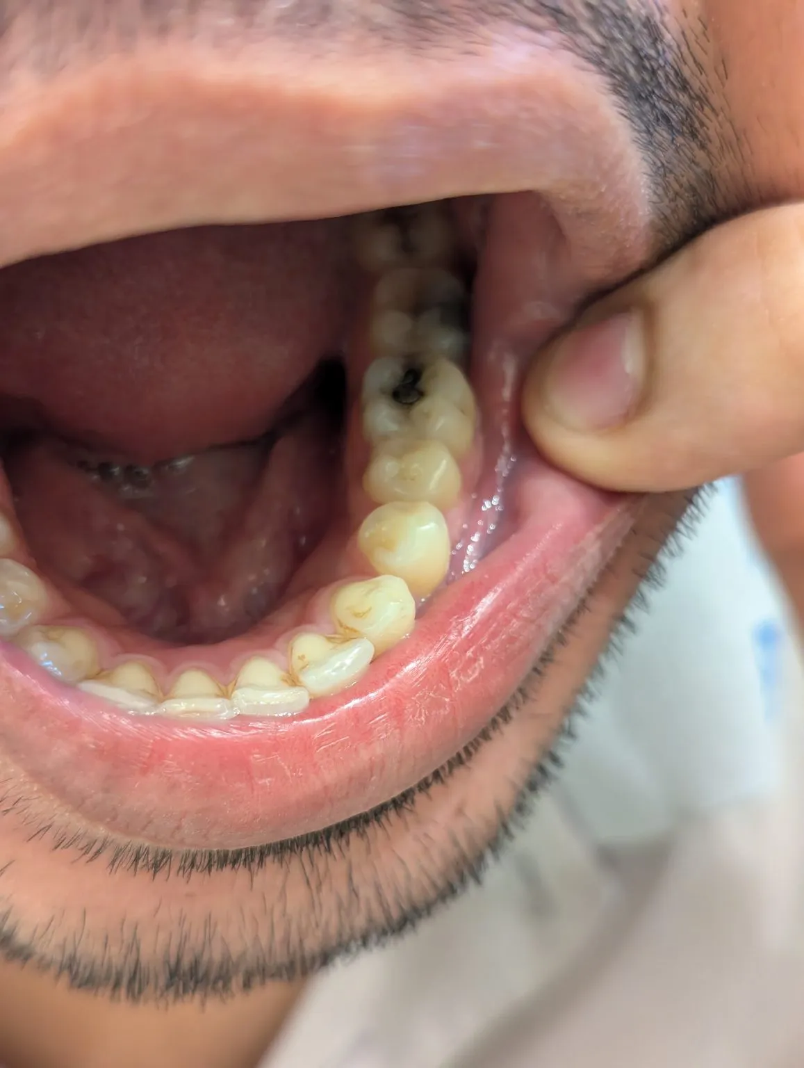 Dental-Carries-into-molar-teeth-1157x1536