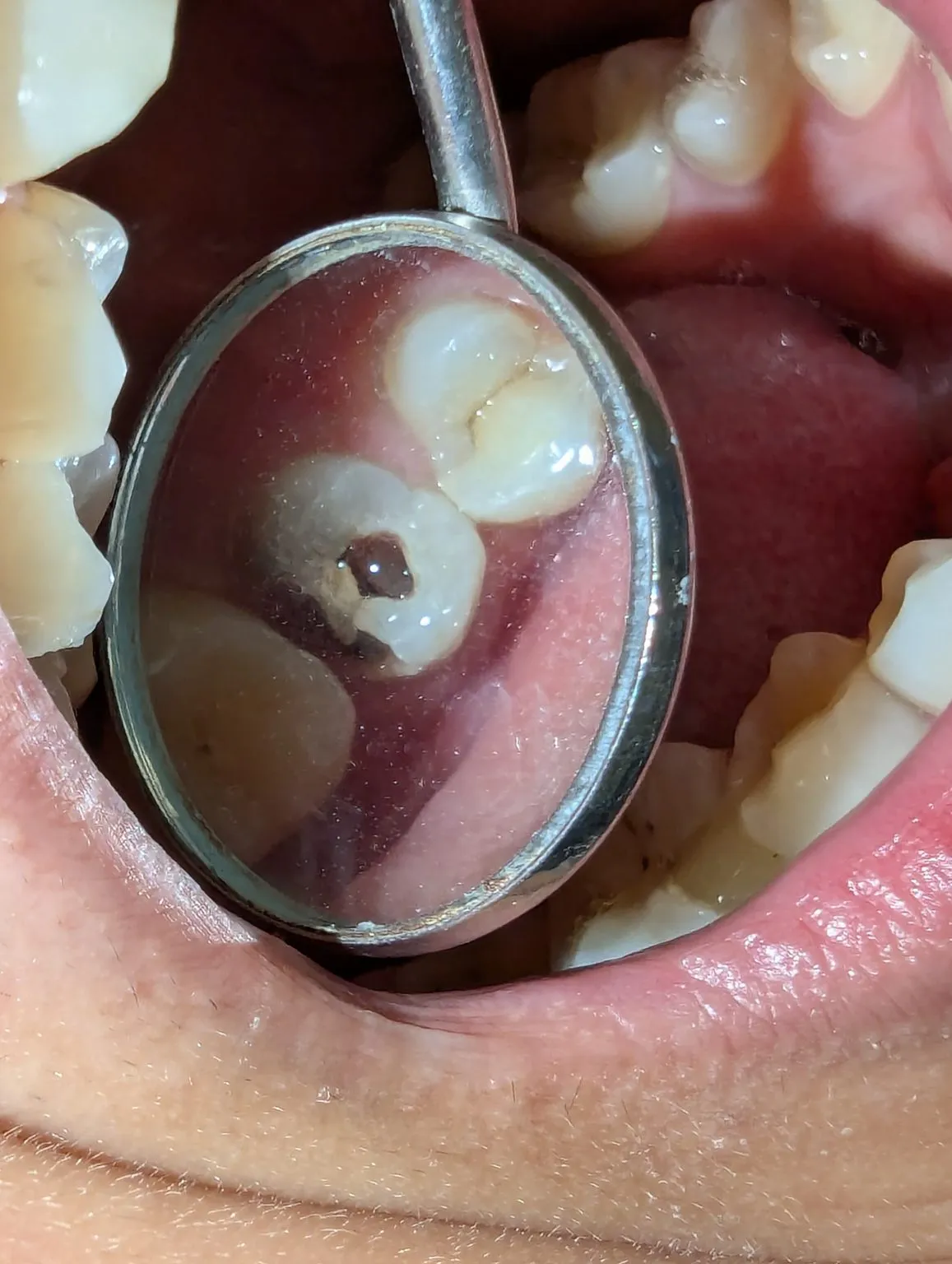 Pus-and-abscess-formation-into-teeth-1157x1536