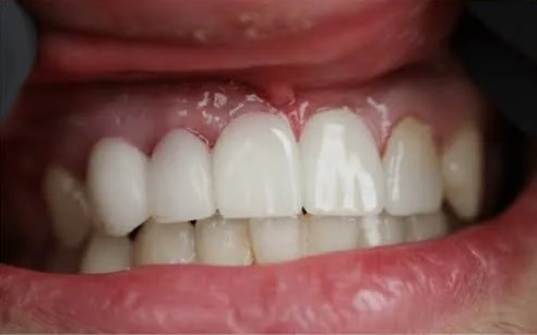 before-and-after-image-of-dental-bridge-of-zirconia-crown