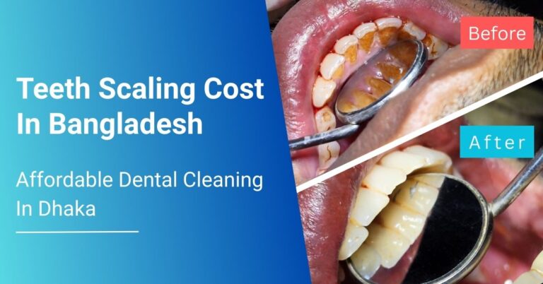 Teeth Scaling Cost In Bangladesh: Affordable Dental Cleaning In Dhaka